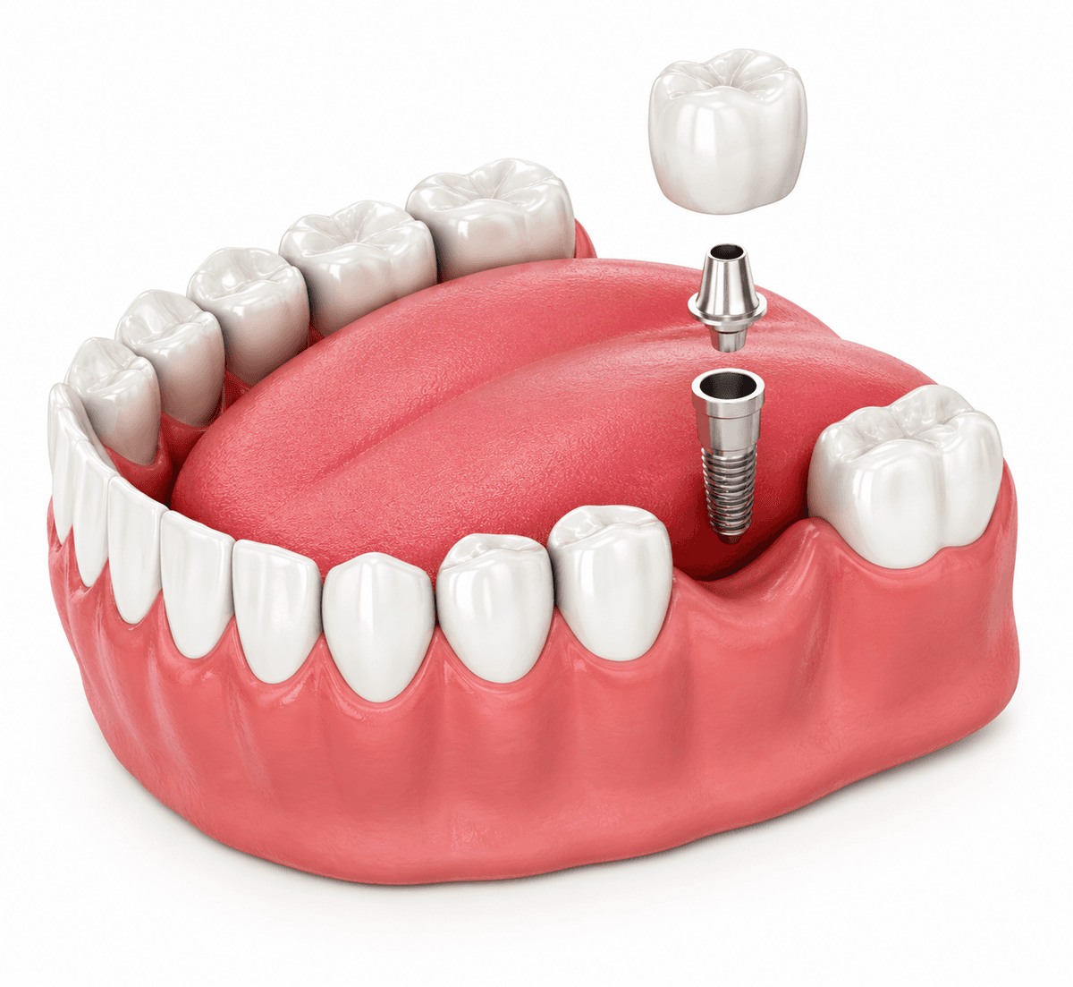 Single Tooth Dental Implant